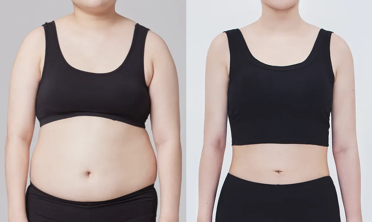 맥미걸 악플콜렉터 수술 전후 의학 사진